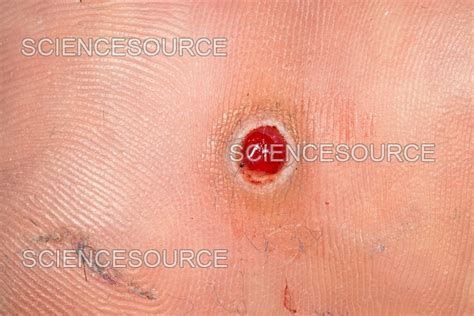 pyogenic granuloma stock image science source images