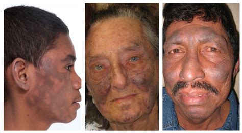 Clinical images of three patients with Hansen’s disease who completed a ...