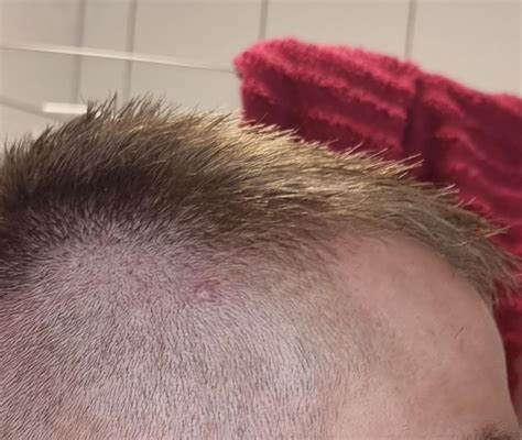 Lump on head : r/DermatologyQuestions