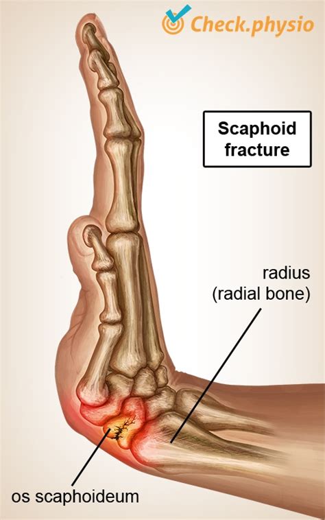 scaphoid fracture physio check