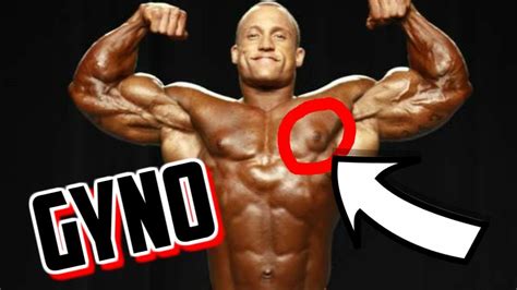 Gyno does not make your pec deformed. An injury does. | Page 2 ...