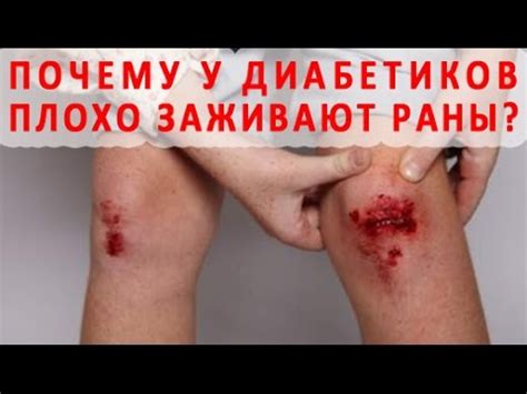 Почему при сахарном диабете плохо заживают раны на коже? - YouTube