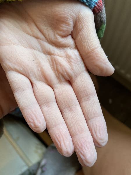 Pitted Keratolysis Hands