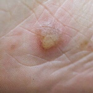 What’s Warts and How to Permanently Remove Warts?