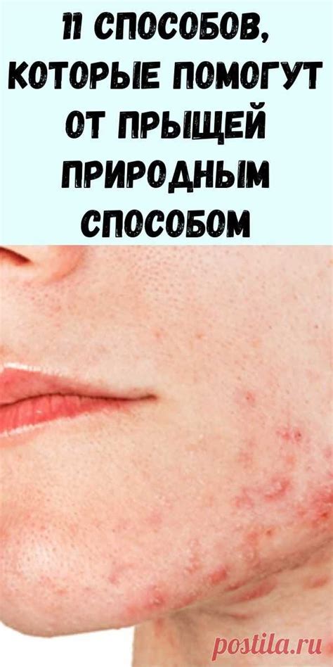 11 способов, которые помогут от прыщей природным способом - Интересный ...