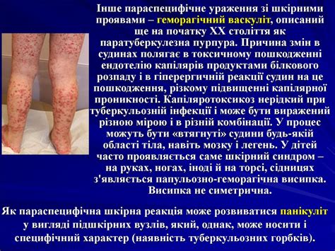 Клінічні форми туберкульозу - презентация онлайн