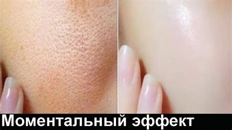 Очищающая и ОТБЕЛИВАЮЩАЯ МАСКА для Жирной кожи лица - YouTube