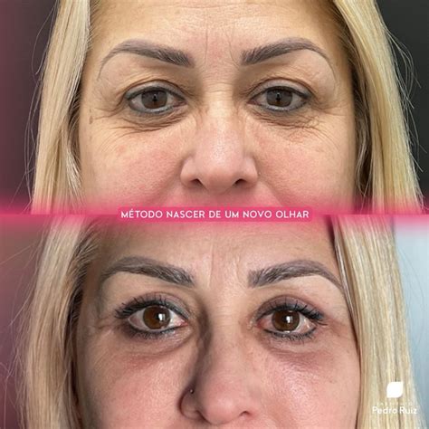 Blefaroplastia Antes E Depois - 5 casos de blefaroplastia antes e depois