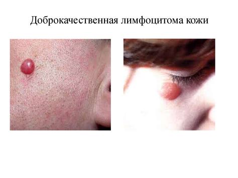 Болезнь Лайма - презентация онлайн