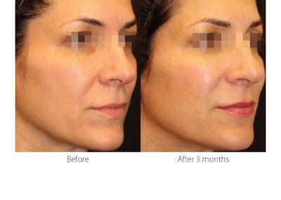 Beautifill Liposuction in Pensacola, FL | Ageless Pensacola