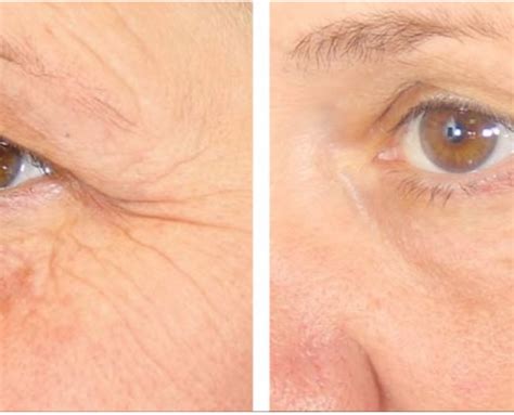 Non Surgical Eye Lift — Advanced Dermatology