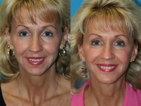 chin augmentation  charleston sc chin surgery