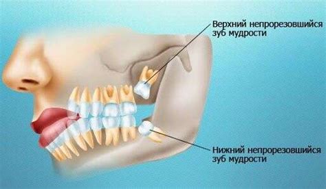 Как выглядит зуб мудрости