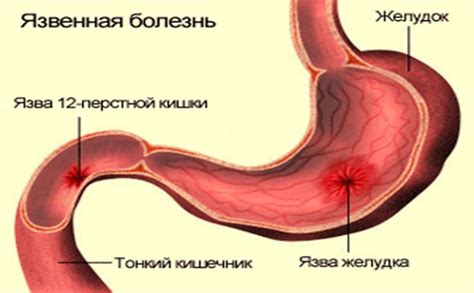 Язва желудка: лечение в клинике Киева | Recovery