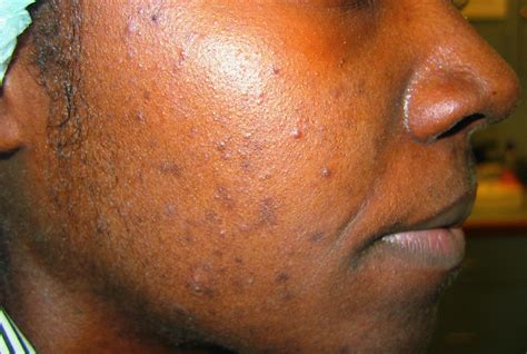 Acne - Skin, Aesthetics & Image Clinic