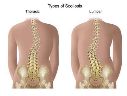 scoliosis exercises schroth 22
