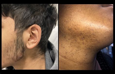 Erythematous Papules and Pustules on Face- Clinical Advisor
