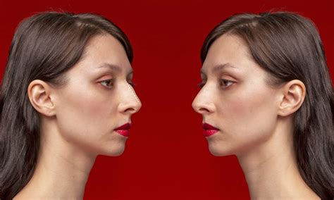 What is Female Rhinoplasty? Rhinoplasty Before and After Female | Hop