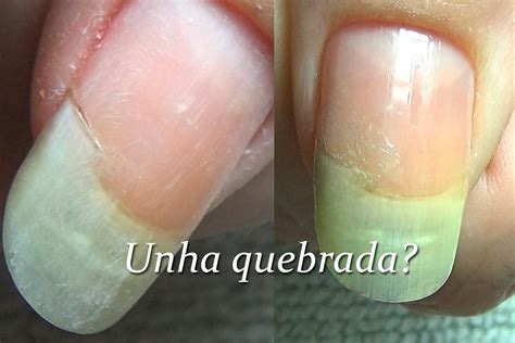 O Que Fazer Quando A Unha Quebra Na Carne