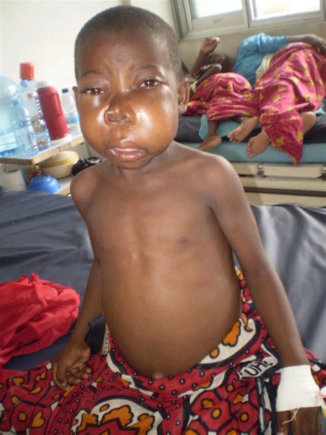 lymphome  kinder hodgkin lymphom bei kindern und jugendlichen srxq