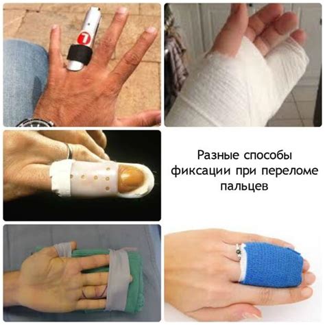 Перелом пальца на руке - симптомы и признаки, лечение, как разработать ...