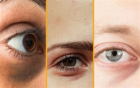 how to fix genetic dark circles