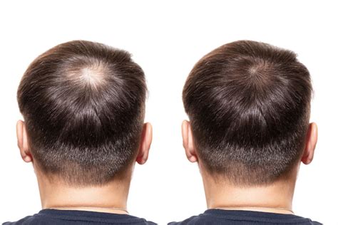 Best GFC PRP Therapy in Thane | Hair Fall Expert in Thane
