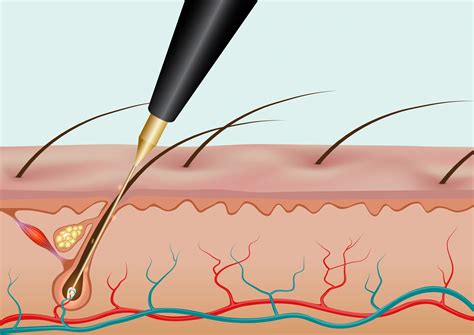 electrolysis for face hair removal 4