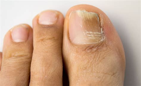 Onychomycosis Treatment