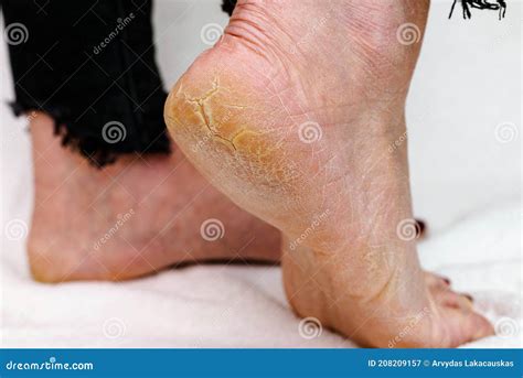 dry  cracked soles  feet womans feet  dry heels cracked skin