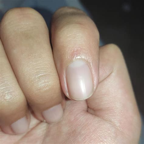 Is this fungal infection? The first one started exactly like the second