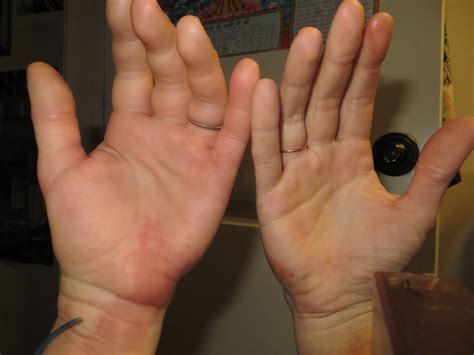 Accidental Insulin Injection Into Vein at Charles Kintore blog