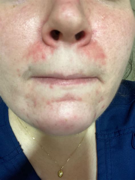 Rosacea or perioral dermatitis? Tips to help heal it? I’ve been dealing