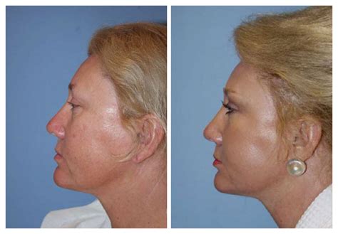 Mid Facelift Naples, FL | Mini & Weekend Facelift Near Me | Fort Myers