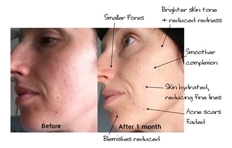 Castor oil melasma before and after face