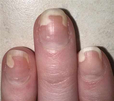 Why do my nails suddenly look like this? : r/medical