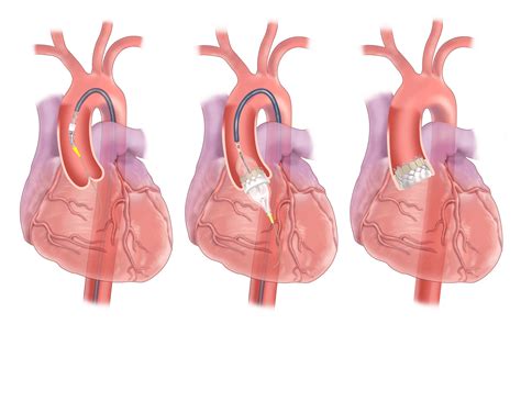 TAVR Procedure | UPMC Heart and Vascular Institute