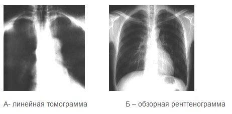 4. Томография (Линейная томография).