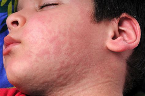 Cold Urticaria Severe Reaction - Infoupdate.org