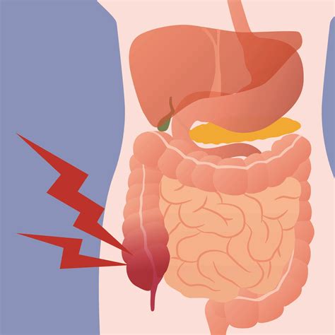Appendicitis Diagnosis