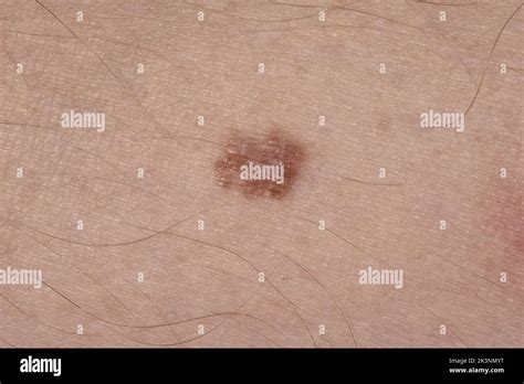 Melanoma in situ Stock Photo - Alamy