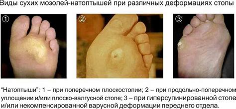 Мозоли на ногах: лечение сухих мозолей, мозолей со стержнем, мокрых ...
