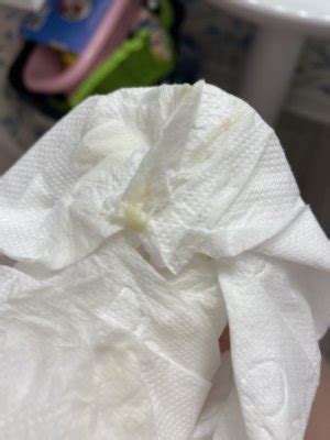 Yellow Clumpy Discharge