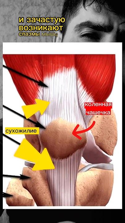 Коленная чашечка ⛑️ вызывает боли в колене⛑️ #здоровье #медицина # ...