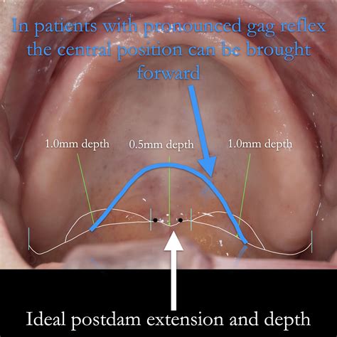 how to stop gag reflex 6
