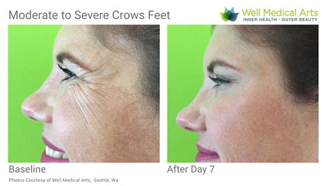 BOTOX Before and After Crows Feet - Well Medical Arts: Seattle's Anti ...