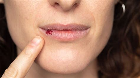 Como Cicatrizar Corte Dentro Da Boca - Corte Na Boca Infectada Tipos De Heridas En La Boca Y Cómo Tratarlas