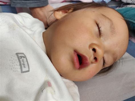 My little daughter with Infantile Acne Scars – Scar treatments – Acne ...