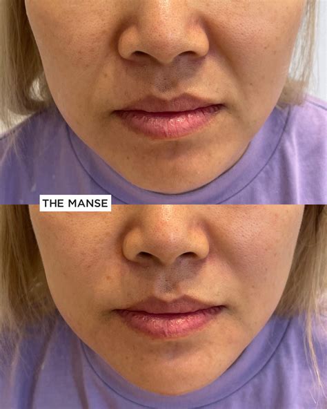 juvederm nasolabial folds    nasolabial folds
