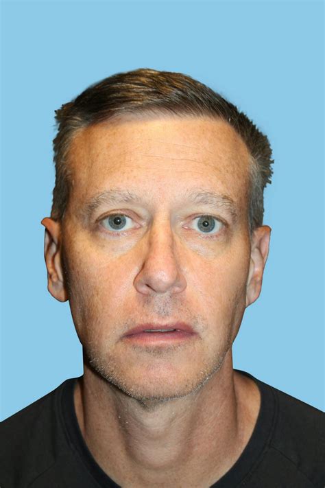 Patient 174920 | Ear Surgery Before & After Photos | Warner Institute